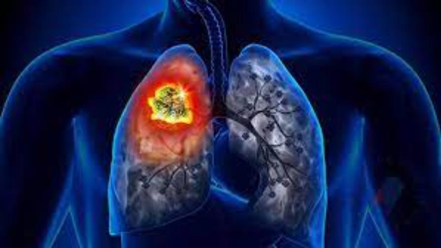 Akciğer Kanseri Hayatta Kalma Oranı