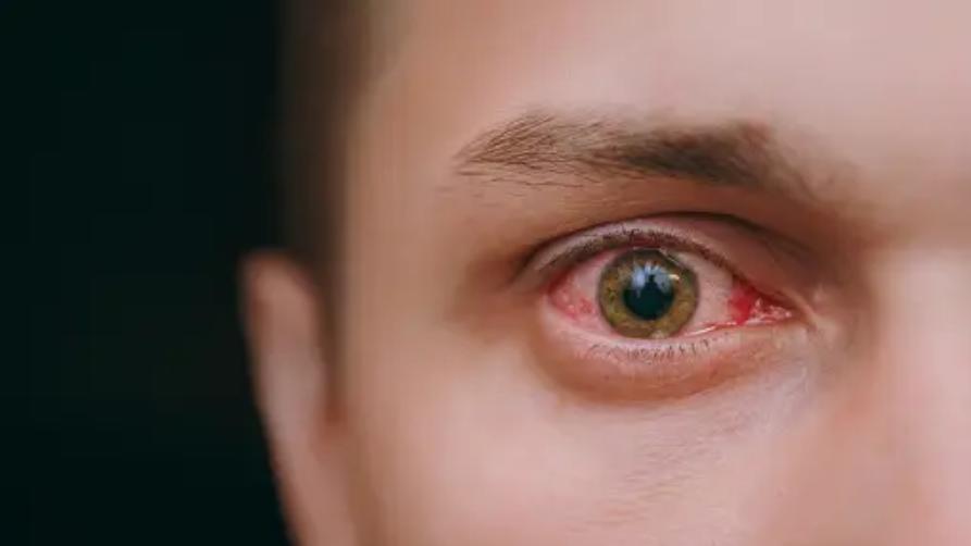 Türkiye’de Keratopigmentasyon Tedavileri: Göz Rengini Değiştirme İşlemi